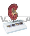 Kidney Stone Model